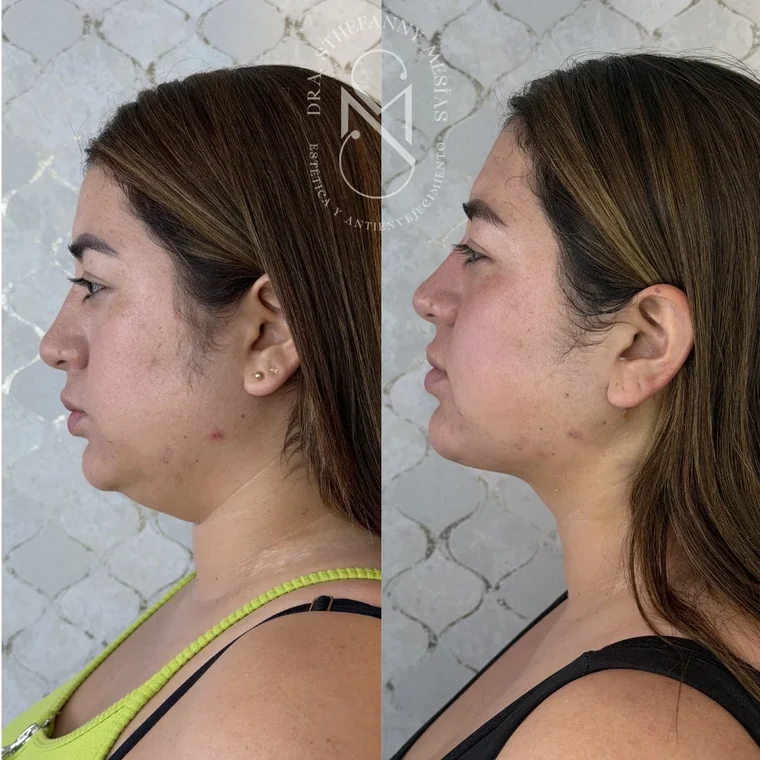 Resultado antes y después de una eliminación de lipopapada realizada por la Dra. Sthefanny Mesías en Cali, caso 5