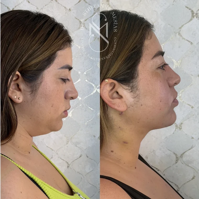 Resultado antes y después de una eliminación de lipopapada realizada por la Dra. Sthefanny Mesías en Cali, caso 6