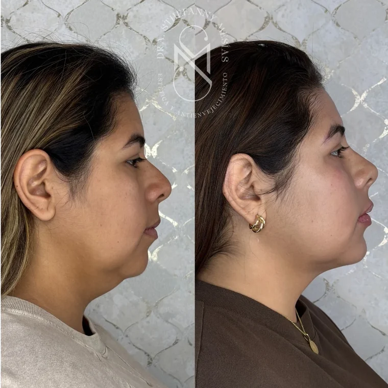 Resultado antes y después de una marcación de mandíbula y mentón realizada por la Dra. Sthefanny Mesías en Cali, caso 1
