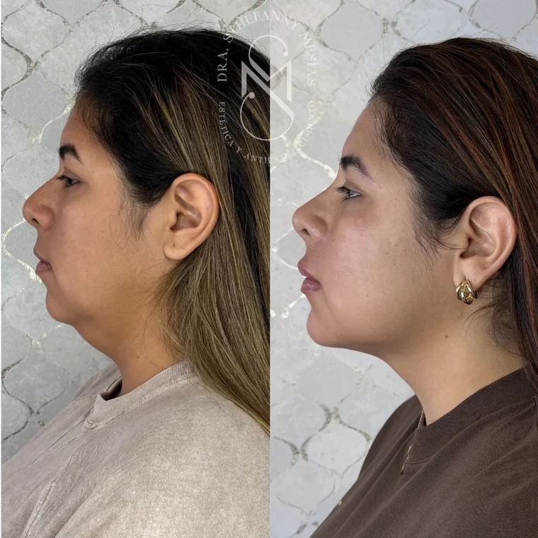 Resultado antes y después de una marcación de mandíbula y mentón realizada por la Dra. Sthefanny Mesías en Cali, caso 2