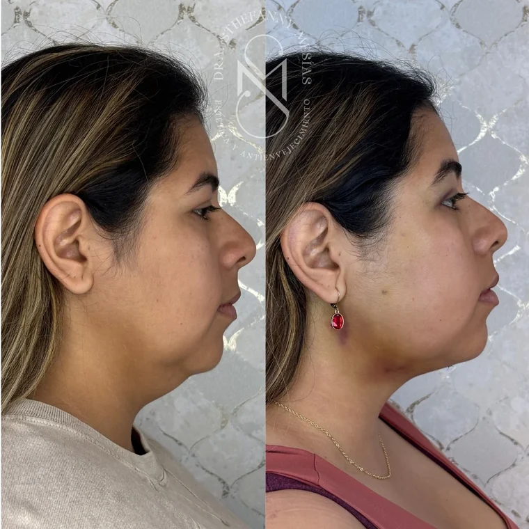 Resultado antes y después de una marcación de mandíbula y mentón realizada por la Dra. Sthefanny Mesías en Cali, caso 3