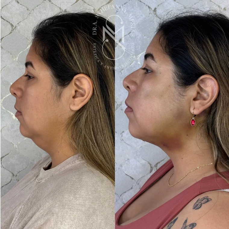 Resultado antes y después de una marcación de mandíbula y mentón realizada por la Dra. Sthefanny Mesías en Cali, caso 4