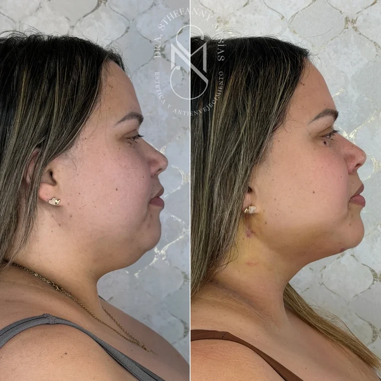 Resultado antes y después de una marcación de mandíbula y mentón realizada por la Dra. Sthefanny Mesías en Cali, caso 5