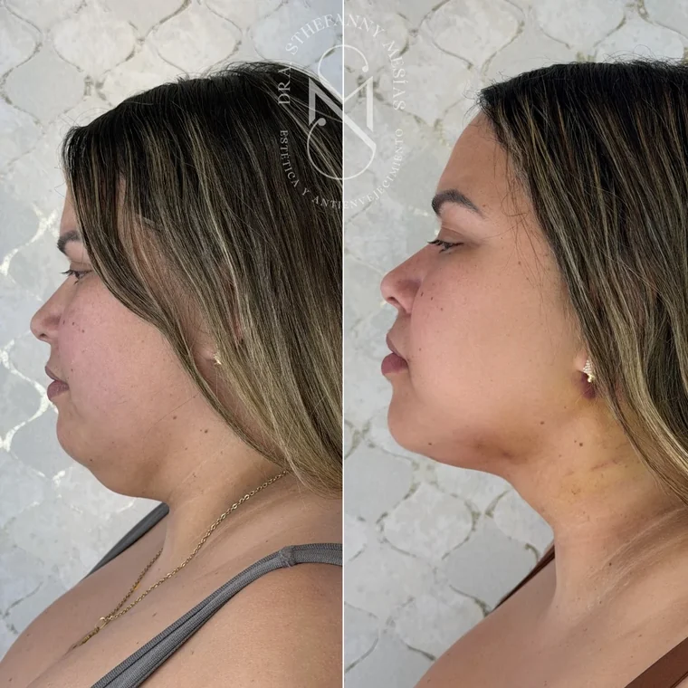Resultado antes y después de una marcación de mandíbula y mentón realizada por la Dra. Sthefanny Mesías en Cali, caso 6