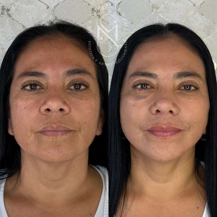 Resultado antes y después de un lifting facial quirúrgico realizado por la Dra. Sthefanny Mesías en Cali, caso 1