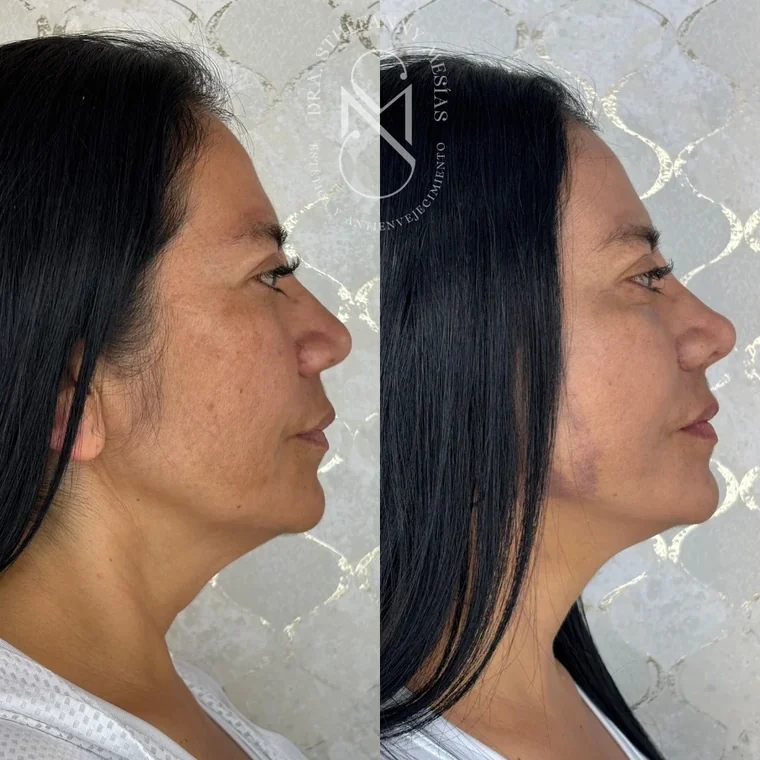 Resultado antes y después de un lifting facial quirúrgico realizado por la Dra. Sthefanny Mesías en Cali, caso 2