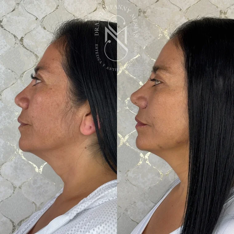 Resultado antes y después de un lifting facial quirúrgico realizado por la Dra. Sthefanny Mesías en Cali, caso 3