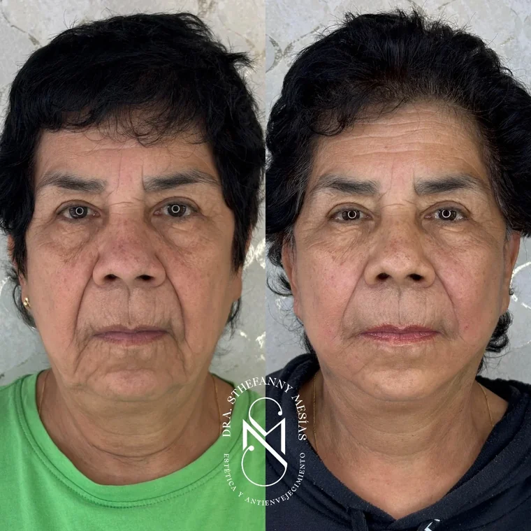 Resultado antes y después de un lifting facial quirúrgico realizado por la Dra. Sthefanny Mesías en Cali, caso 4