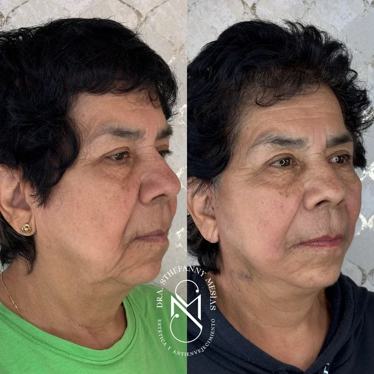 Resultado antes y después de un lifting facial quirúrgico realizado por la Dra. Sthefanny Mesías en Cali, caso 5