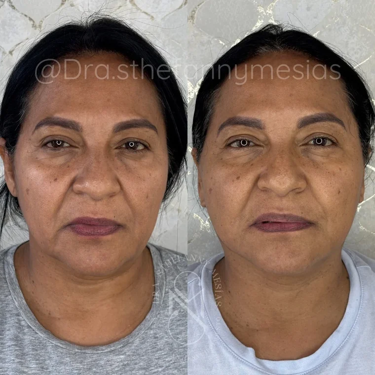 Resultado antes y después de un lifting facial quirúrgico realizado por la Dra. Sthefanny Mesías en Cali, caso 6