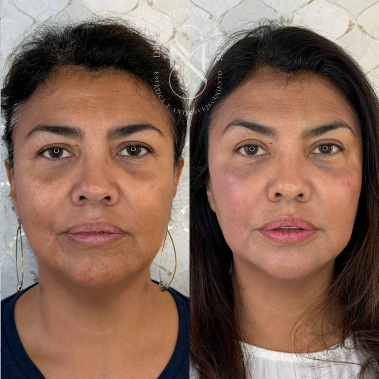 Resultado antes y después de un tratamiento de ojeras con ácido hialurónico realizado por la Dra. Sthefanny Mesías en Cali, caso 1