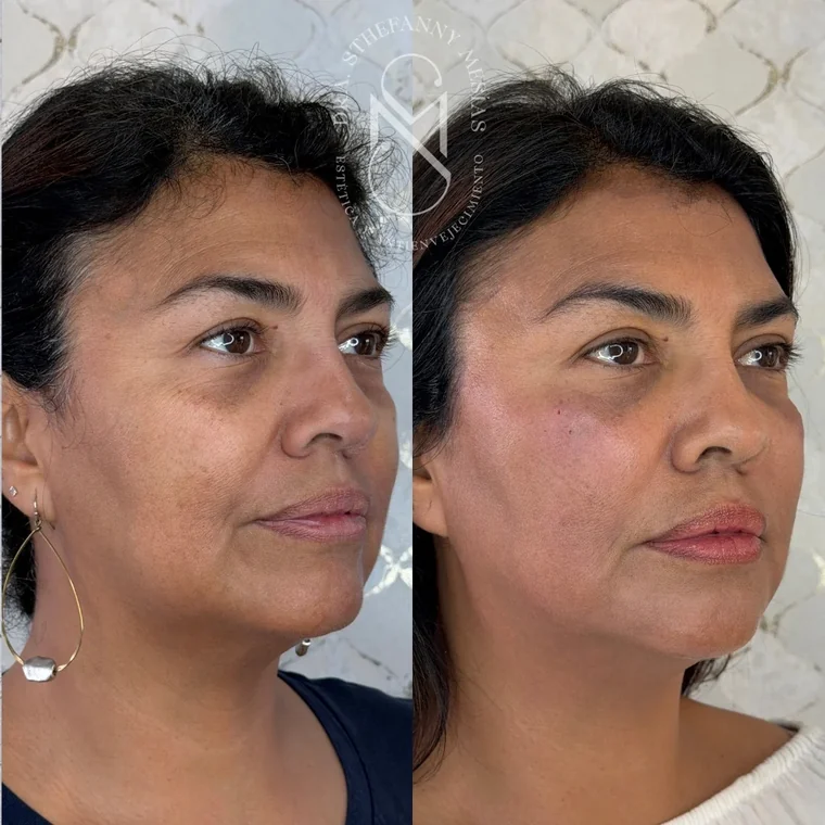 Resultado antes y después de un tratamiento de ojeras con ácido hialurónico realizado por la Dra. Sthefanny Mesías en Cali, caso 2