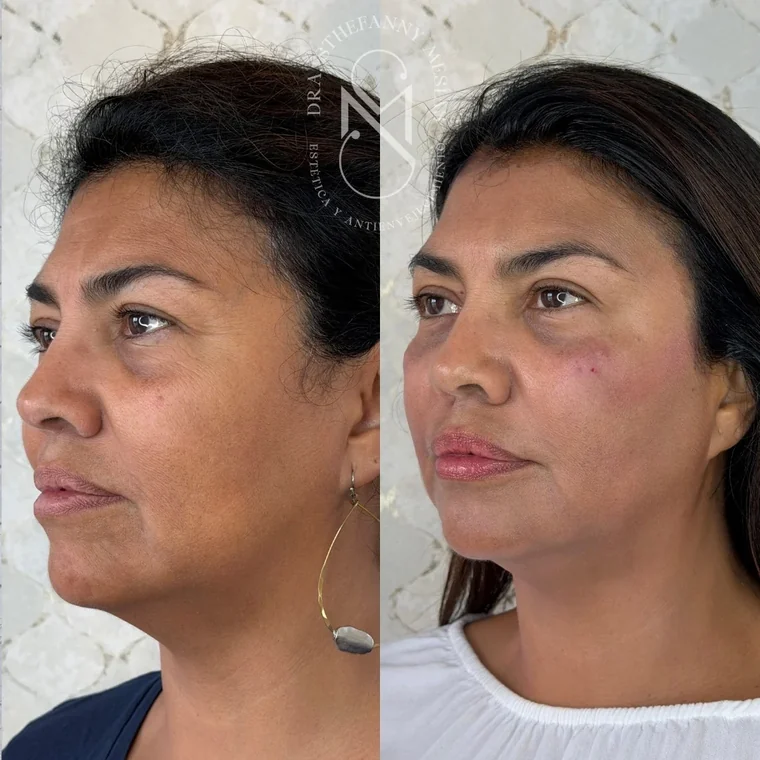 Resultado antes y después de un tratamiento de ojeras con ácido hialurónico realizado por la Dra. Sthefanny Mesías en Cali, caso 3