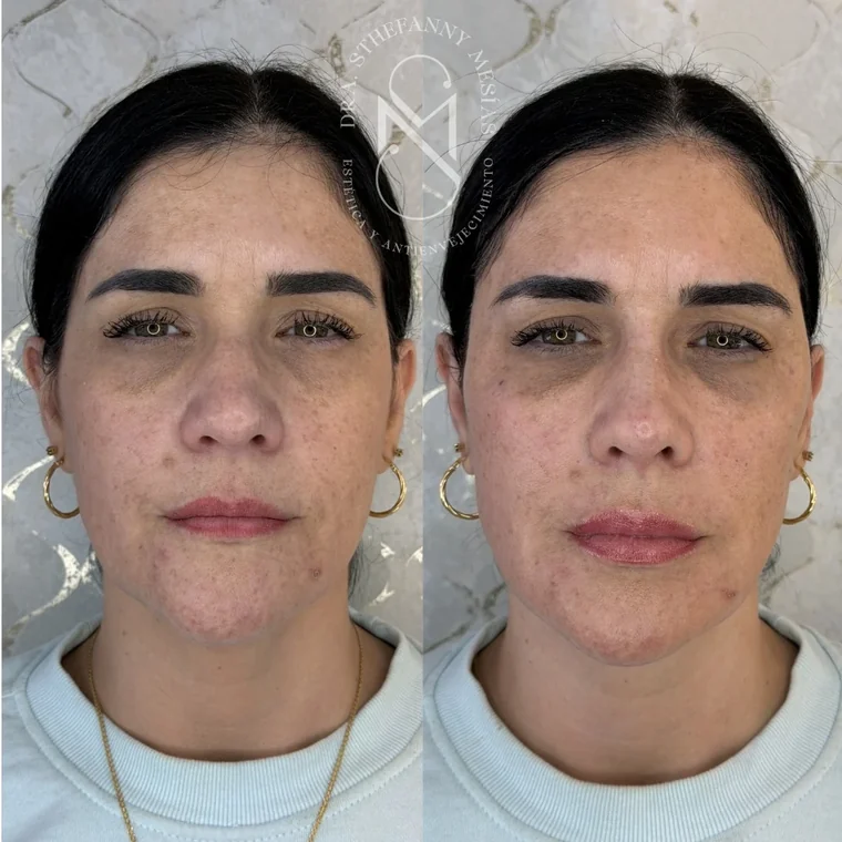Resultado antes y después de un tratamiento de ojeras con ácido hialurónico realizado por la Dra. Sthefanny Mesías en Cali, caso 5