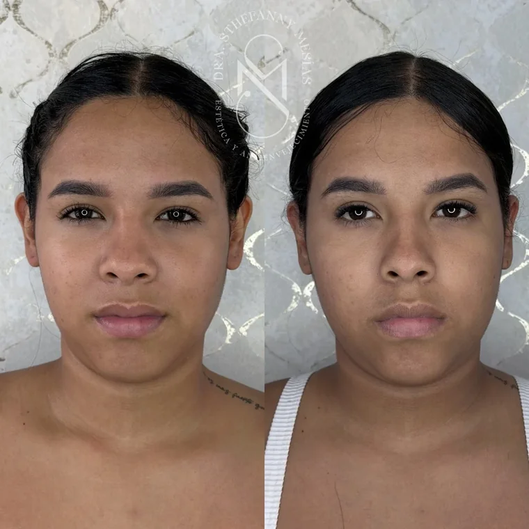 Resultado antes y después de una otoplastia realizada por la Dra. Sthefanny Mesías en Cali, caso 2