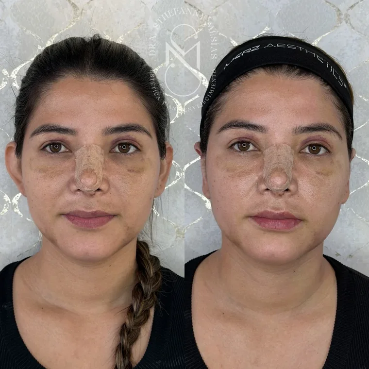 Resultado antes y después de una otoplastia realizada por la Dra. Sthefanny Mesías en Cali, caso 4