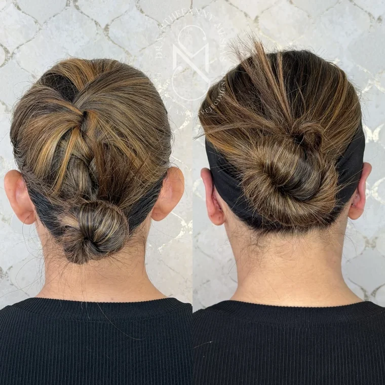 Resultado antes y después de una otoplastia realizada por la Dra. Sthefanny Mesías en Cali, caso 5