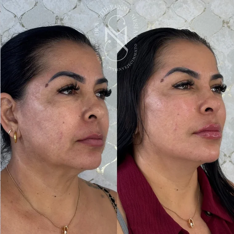 Resultado antes y después de una marcación de pómulos con ácido hialurónico realizada por la Dra. Sthefanny Mesías en Cali, caso 3