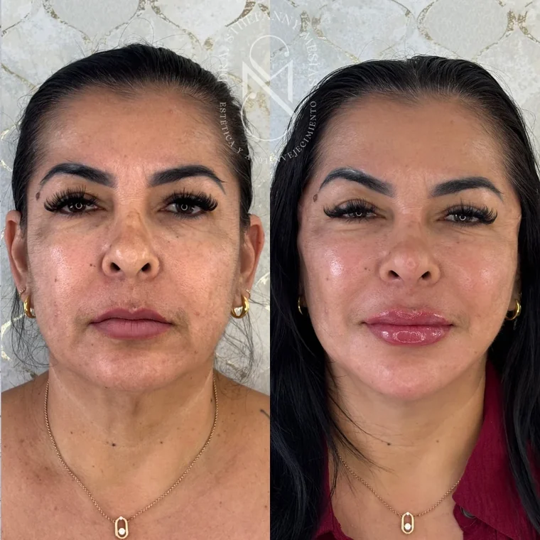 Resultado antes y después de una marcación de pómulos con ácido hialurónico realizada por la Dra. Sthefanny Mesías en Cali, caso 4