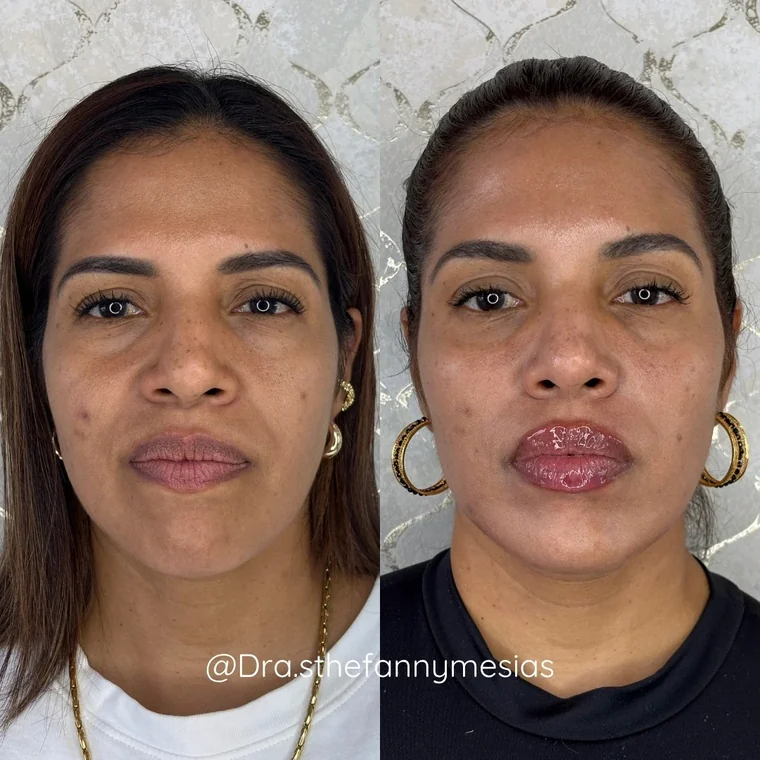 Resultado antes y después de una marcación de pómulos con ácido hialurónico realizada por la Dra. Sthefanny Mesías en Cali, caso 5