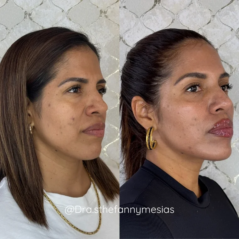 Resultado antes y después de una marcación de pómulos con ácido hialurónico realizada por la Dra. Sthefanny Mesías en Cali, caso 6