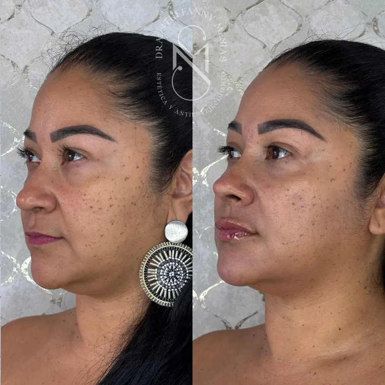 Resultado antes y después de un tratamiento con hidroxiapatita de calcio realizado por la Dra. Sthefanny Mesías en Cali, caso 1