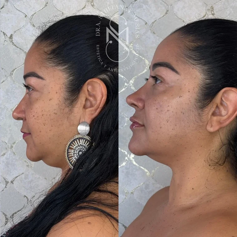 Resultado antes y después de un tratamiento con hidroxiapatita de calcio realizado por la Dra. Sthefanny Mesías en Cali, caso 2