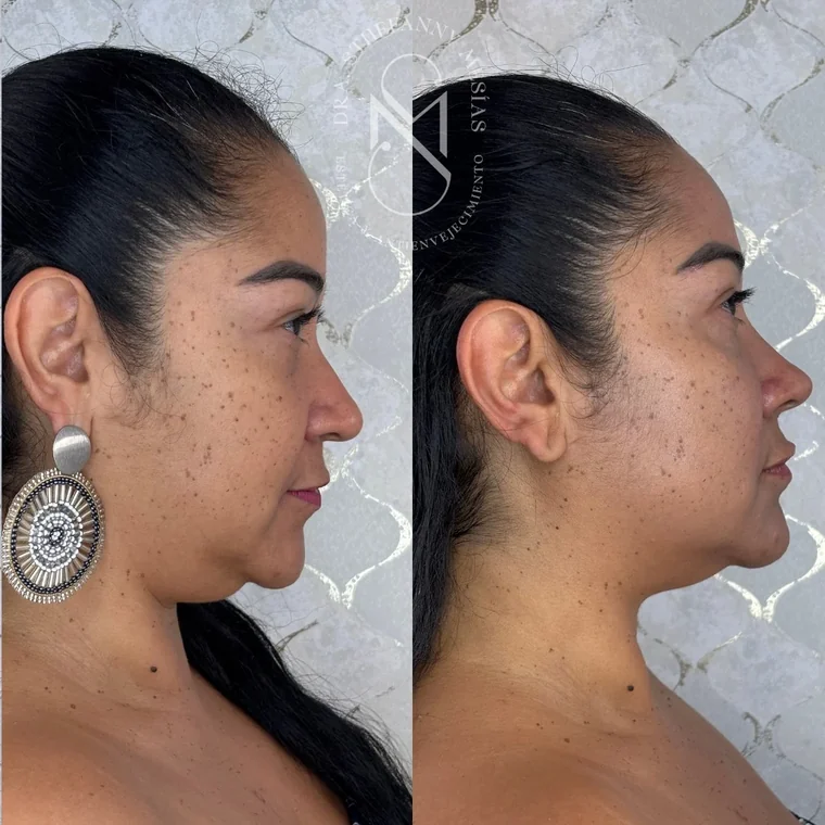 Resultado antes y después de un tratamiento con hidroxiapatita de calcio realizado por la Dra. Sthefanny Mesías en Cali, caso 3