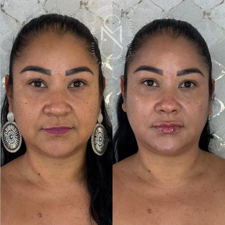 Resultado antes y después de un tratamiento con hidroxiapatita de calcio realizado por la Dra. Sthefanny Mesías en Cali, caso 4
