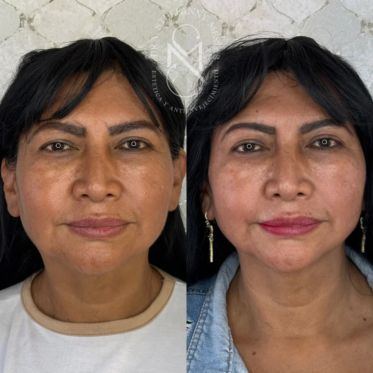 Resultado antes y después de un tratamiento de rejuvenecimiento facial realizado por la Dra. Sthefanny Mesías en Cali, caso 5
