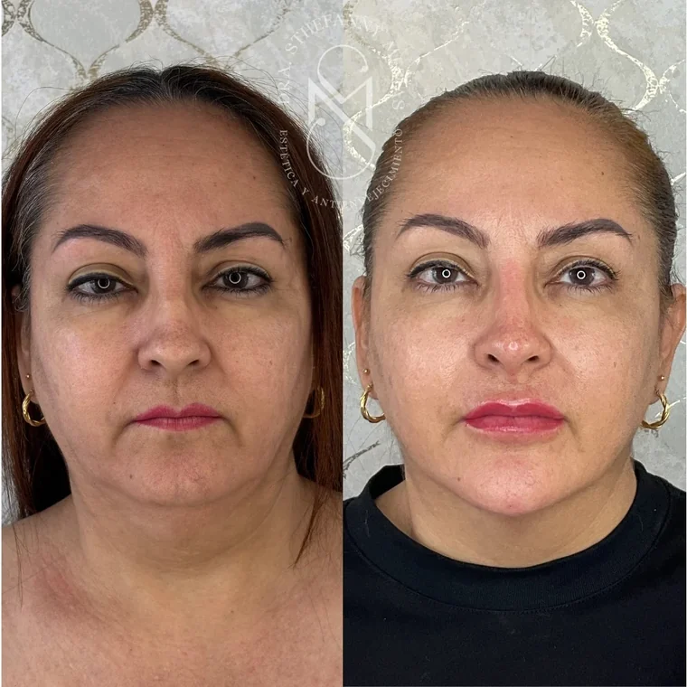Resultado antes y después de un tratamiento de rejuvenecimiento facial realizado por la Dra. Sthefanny Mesías en Cali, caso 6