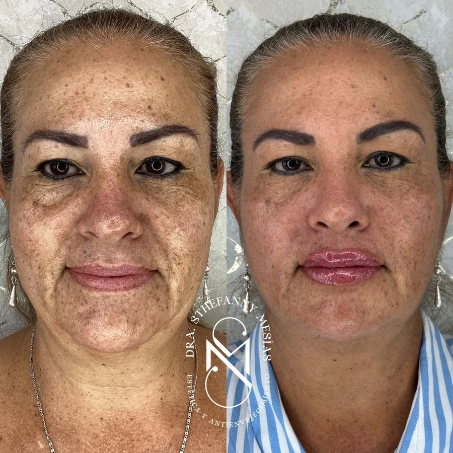 Resultado antes y después de una armonización facial completa realizada en Cali