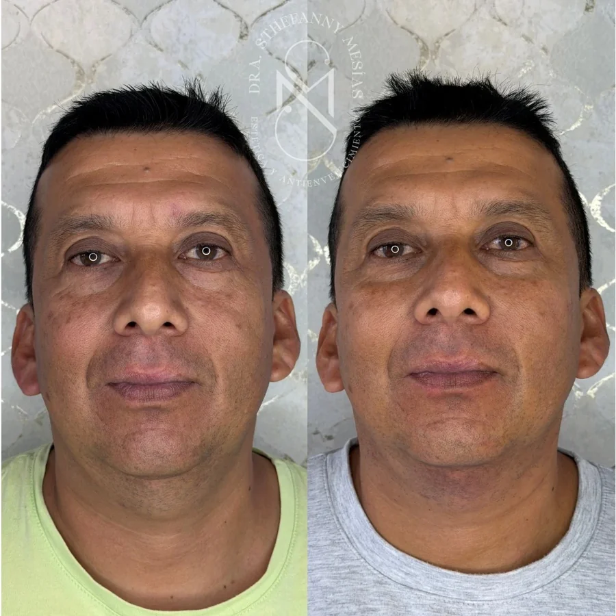 Resultado antes y después de un endolifting facial realizado en Cali