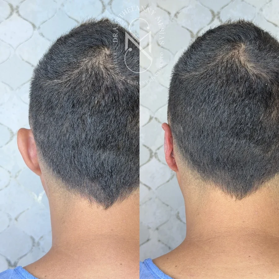 Resultado antes y después de una otoplastia para corregir orejas prominentes en Cali