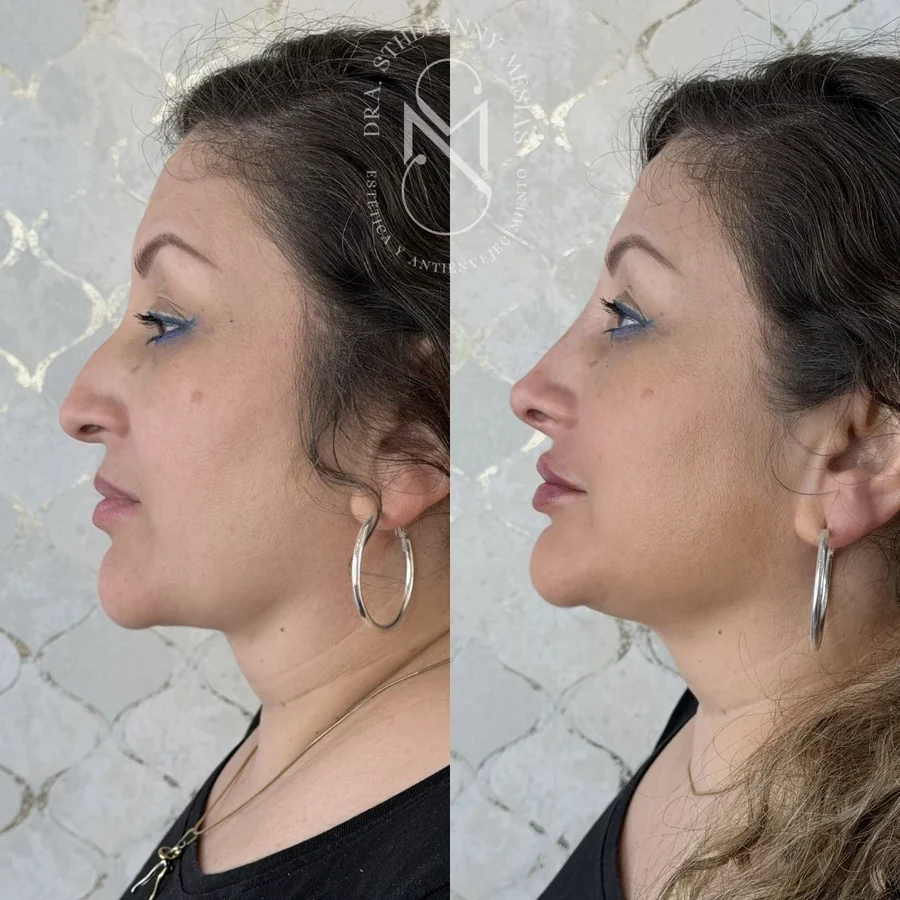 Resultado antes y después de una rinomodelación con ácido hialurónico realizada en Cali