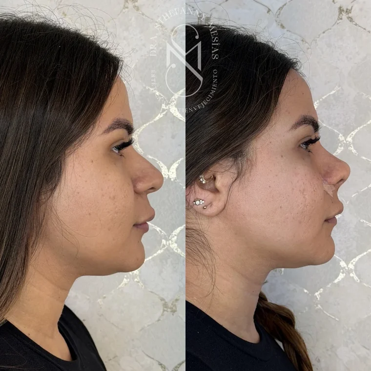 Resultado antes y después de RinoDelux, rinomodelación integral realizada por la Dra. Sthefanny Mesías en Cali, caso 1