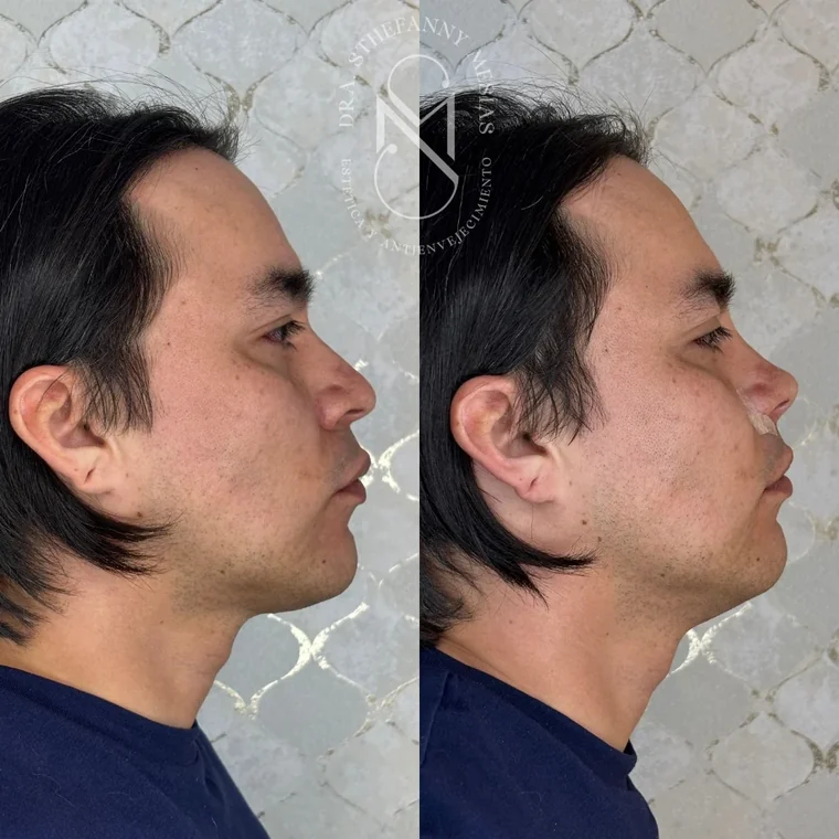 Resultado antes y después de RinoDelux, rinomodelación integral realizada por la Dra. Sthefanny Mesías en Cali, caso 2