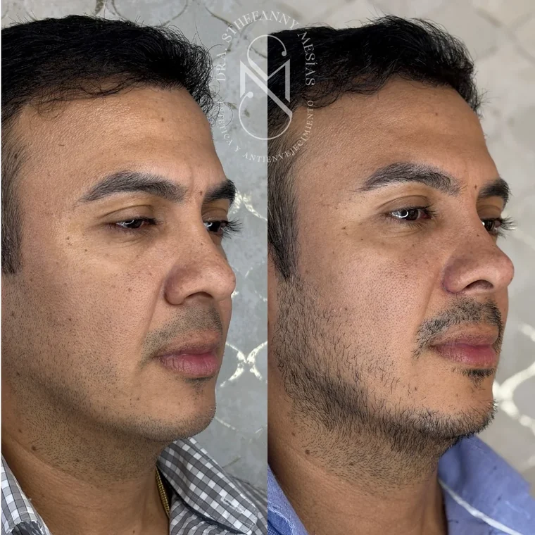 Resultado antes y después de RinoDelux, rinomodelación integral realizada por la Dra. Sthefanny Mesías en Cali, caso 3