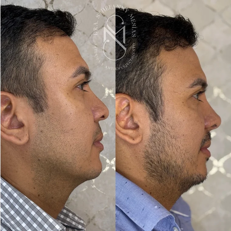 Resultado antes y después de RinoDelux, rinomodelación integral realizada por la Dra. Sthefanny Mesías en Cali, caso 4