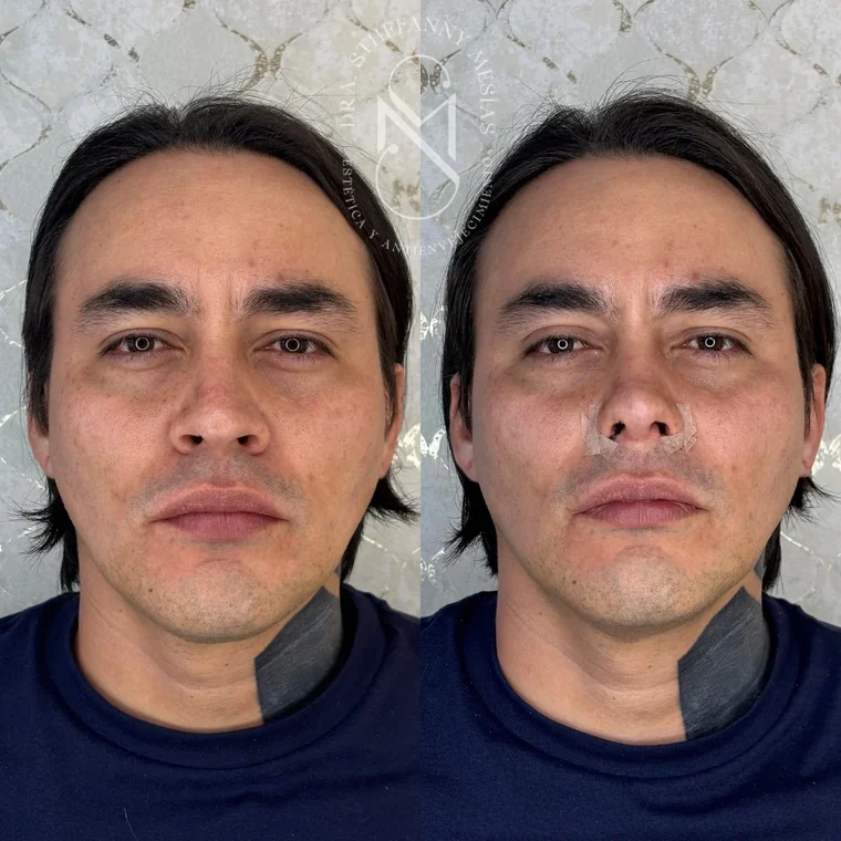 Resultado antes y después de RinoDelux, rinomodelación integral realizada por la Dra. Sthefanny Mesías en Cali, caso 5
