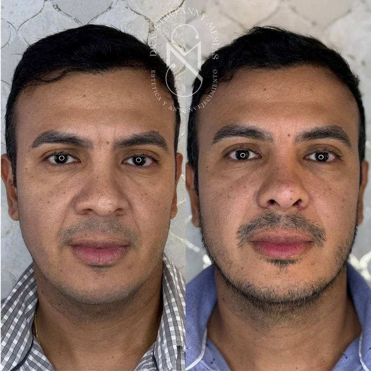 Resultado antes y después de RinoDelux, rinomodelación integral realizada por la Dra. Sthefanny Mesías en Cali, caso 6