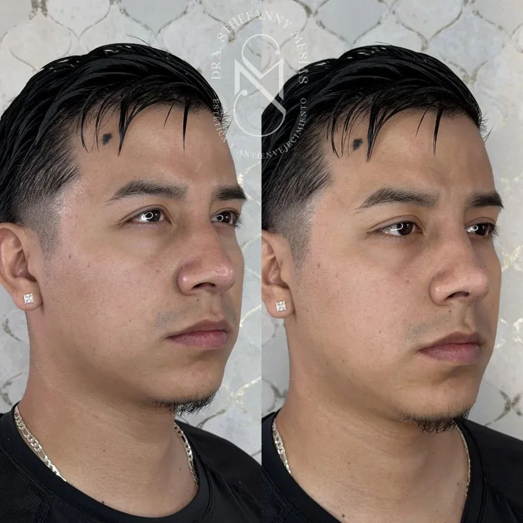 Resultado antes y después de una rinomodelación realizada por la Dra. Sthefanny Mesías en Cali, caso 1