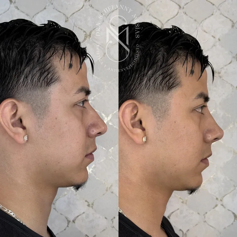 Resultado antes y después de una rinomodelación realizada por la Dra. Sthefanny Mesías en Cali, caso 2