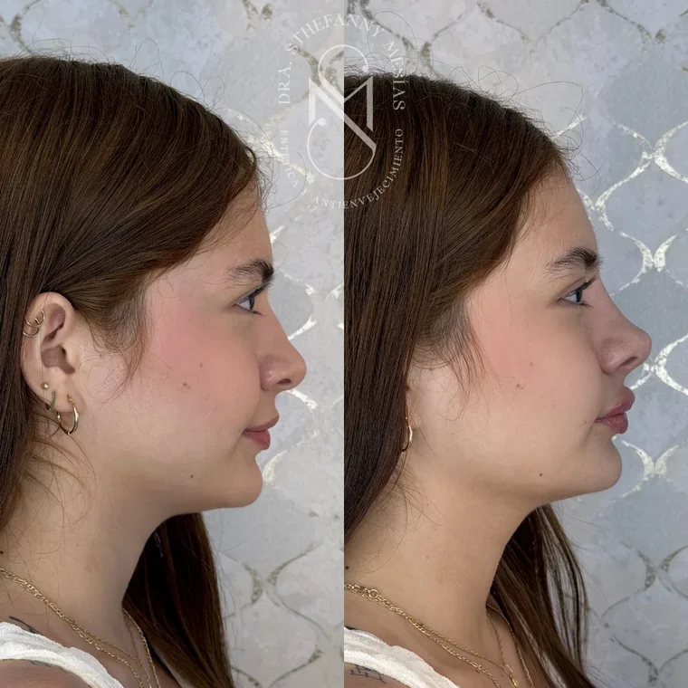 Resultado antes y después de una rinomodelación realizada por la Dra. Sthefanny Mesías en Cali, caso 5