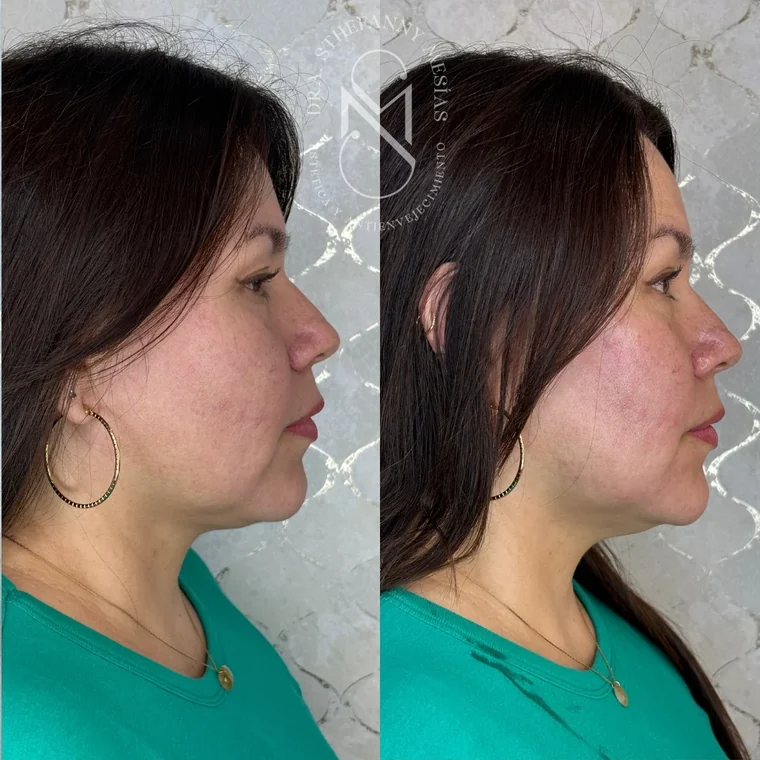 Resultado antes y después de un tratamiento con ácido poli-L-láctico realizado por la Dra. Sthefanny Mesías en Cali, caso 2