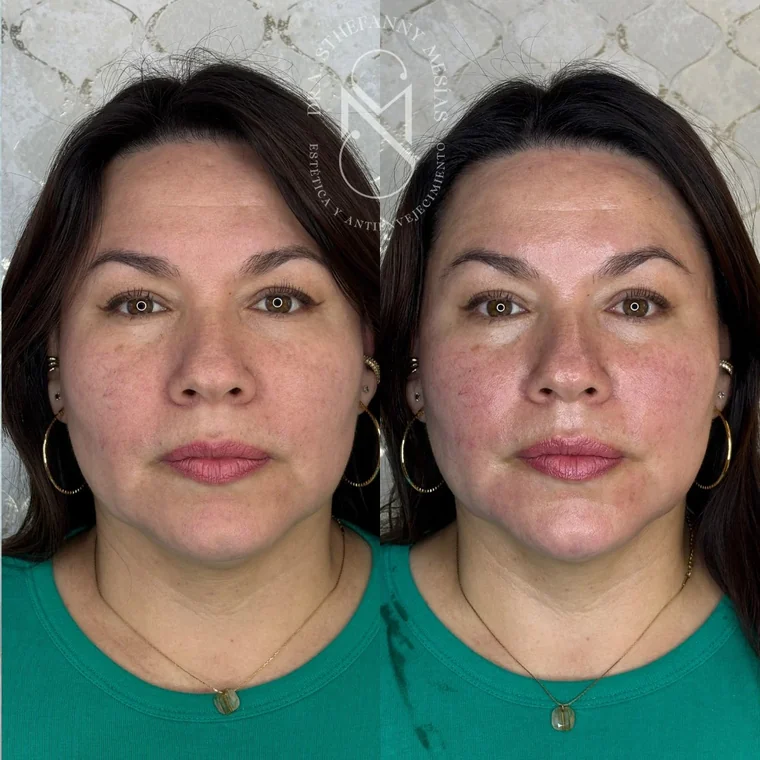 Resultado antes y después de un tratamiento con ácido poli-L-láctico realizado por la Dra. Sthefanny Mesías en Cali, caso 3