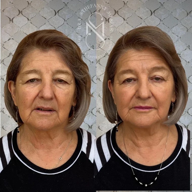 Resultado antes y después de un tratamiento con ácido poli-L-láctico realizado por la Dra. Sthefanny Mesías en Cali, caso 4