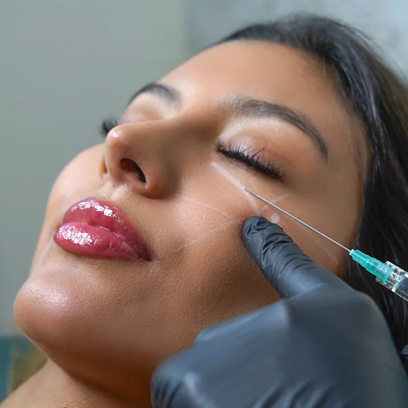 Aplicación de bioestimuladores de colágeno en el rostro en Cali
