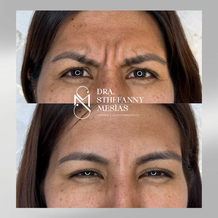 Resultado antes y después de una aplicación de toxina botulínica realizada por la Dra. Sthefanny Mesías en Cali, caso 1