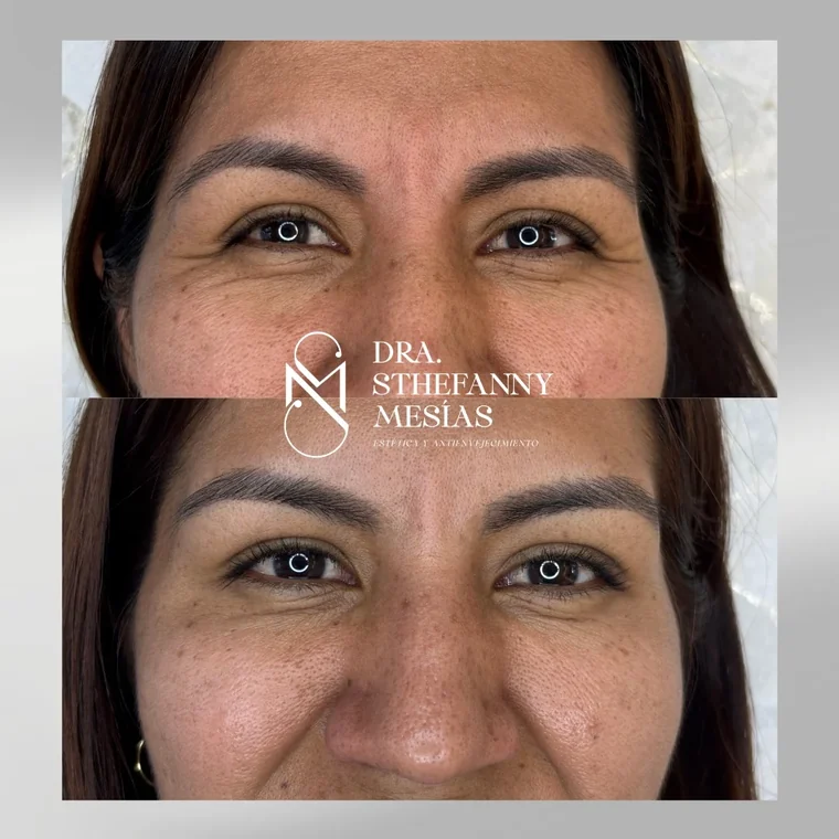 Resultado antes y después de una aplicación de toxina botulínica realizada por la Dra. Sthefanny Mesías en Cali, caso 3